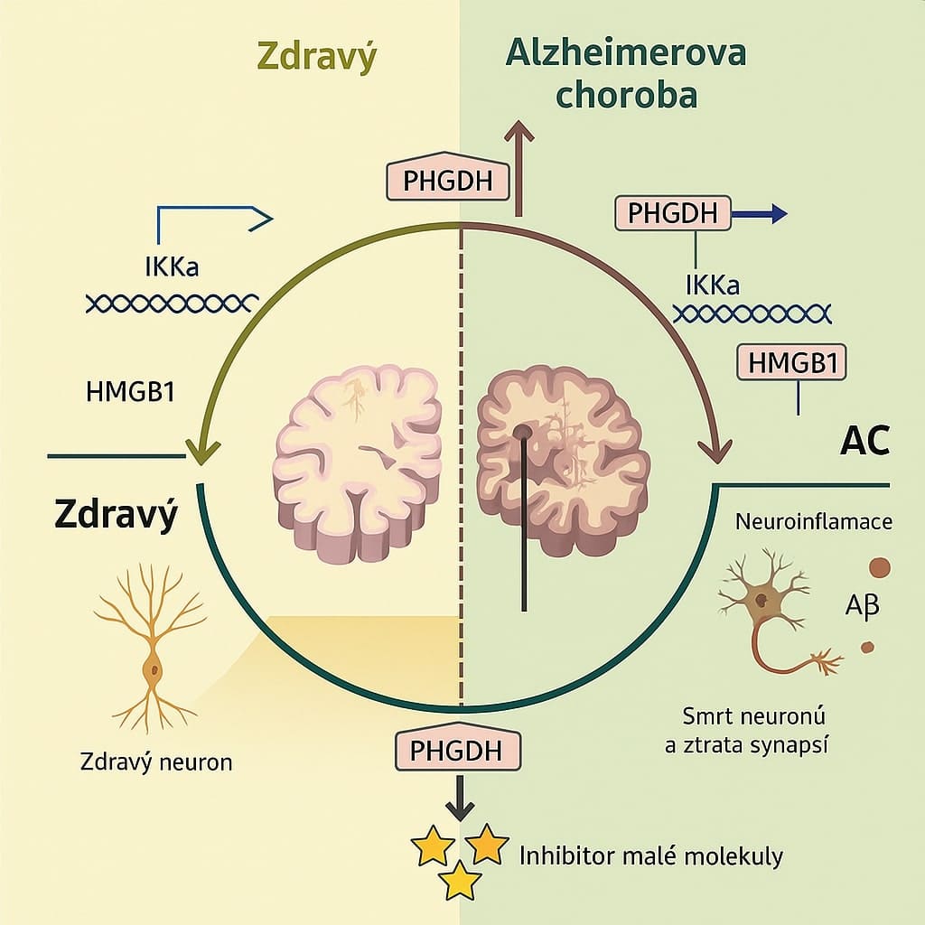 Alzheimerova choroba